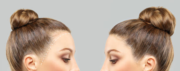 La greffe de cheveux est une solution chirurgicale contre la perte de cheveux. En effet, elle permet de restaurer la densité capillaire.